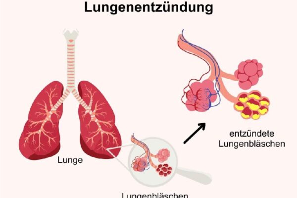 wie schnell stirbt man bei lungenentzündung