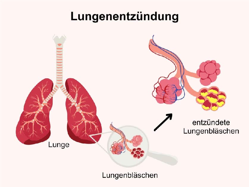 wie schnell stirbt man bei lungenentzündung